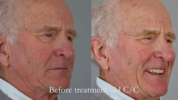 Complete denture Class II div 2 deep overbite Newsletter 39