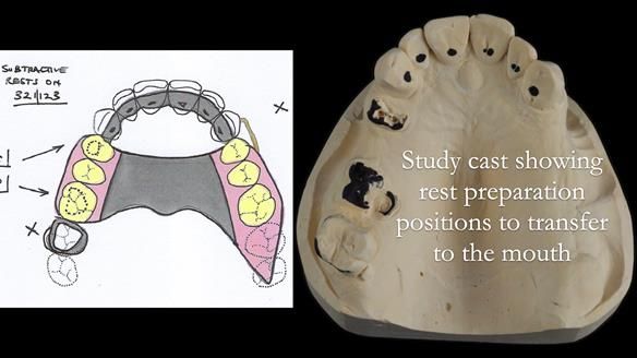 Finlay's Newsletter 60 Sylvia's upper Kennedy Class 2 Mod 1 metal based upper RPD