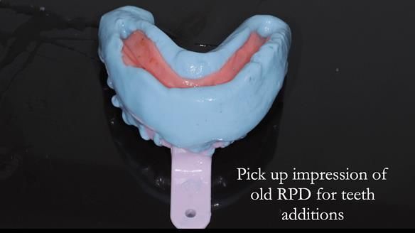 Finlay's Newsletter 62 provision of extractions and metal based complete dentures for Rafique