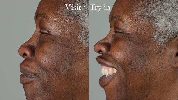 Newsletter 53 showing the making and fitting of ultra life-like dentures for Valena