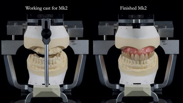 Newsletter 77: Jeremy’s case – immediate complete upper denture