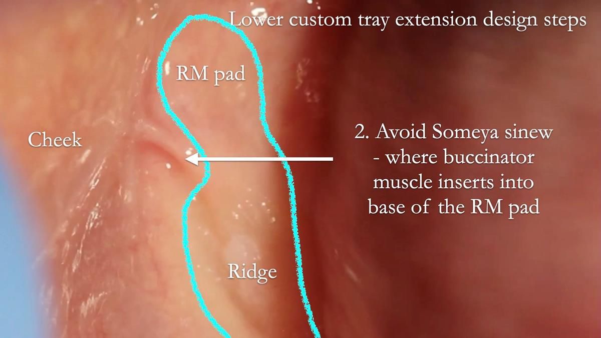 Fin’s Newsletter 88 — Complete dentures - full protocol… he rearranged his own teeth!
