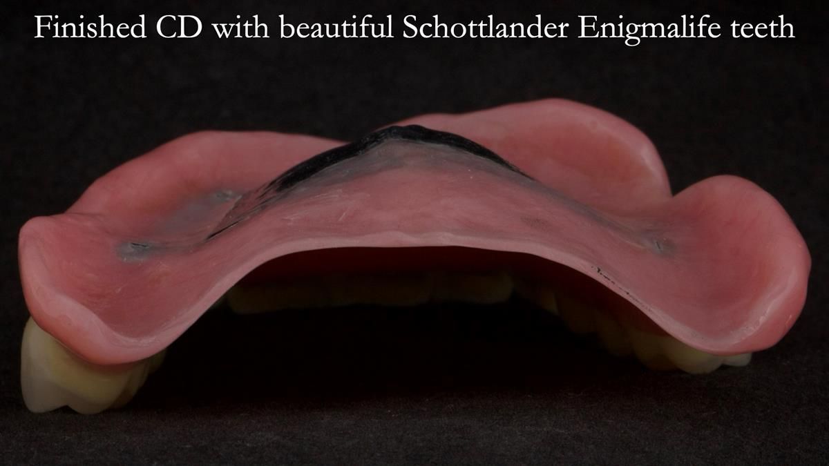 Newsletter 87 – Father Peter: A Partial Denture that needed Minor Miracle