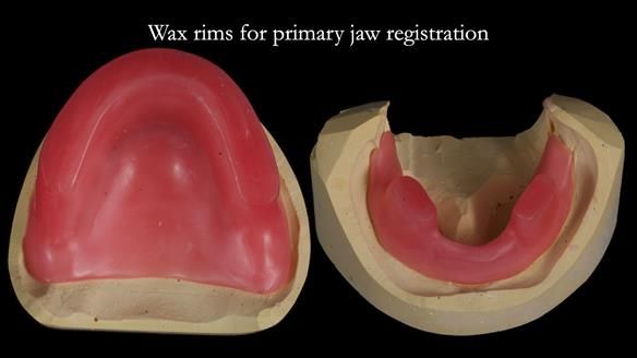Newsletter 83: Sheila’s Complete Denture Success