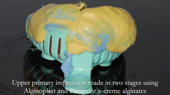 Newsletter 56 showing the making and fitting of a bilateral free end saddle upper removable partial denture (RPD) for patient with pemphigus