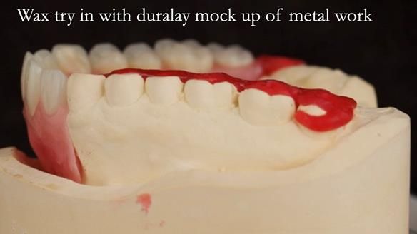 Upper metal base partial denture/occlusal stabilisation splint/obturator - full protocol