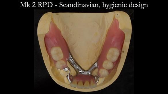 Finlay's Case Study Newsletter 40 - Immediate Mk 1 RPD to Definitive Mk 2 RPD - full protocol
