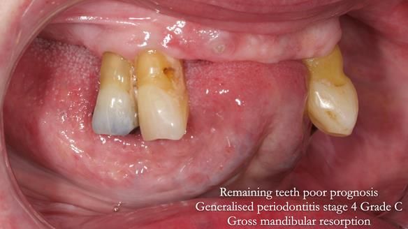 Finlay's Newsletter 59 Ultra hard partial dentures made for Gill