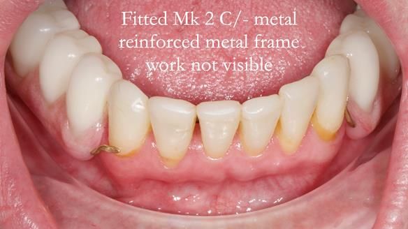 Newsletter 52 Managing Jo’s failing dentition with extractions and Mk 1/Mk 2 complete upper dentures and lower partial dentures FULL PROTOCOL