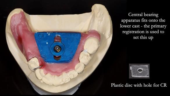 Newsletter 54 case presentation upper complete denture and lower Scandinavian designed hygienic partial denture for David
