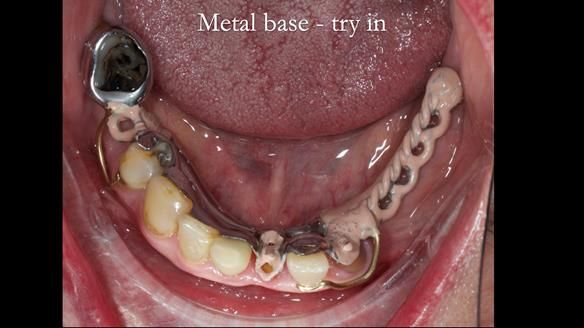 Newsletter 55 Provision of metal based partial dentures for Zephyrine with a repaired cleft lip and palate