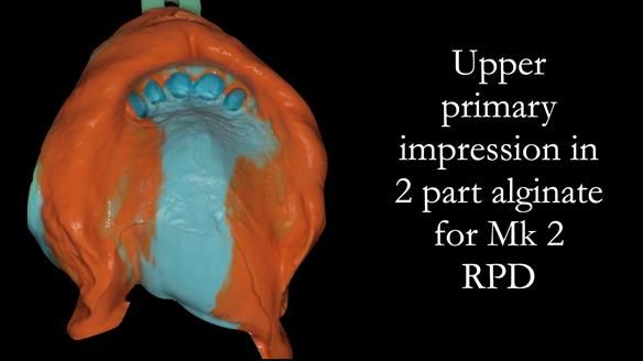 Finlay's Case Study Newsletter 40 - Immediate Mk 1 RPD to Definitive Mk 2 RPD - full protocol