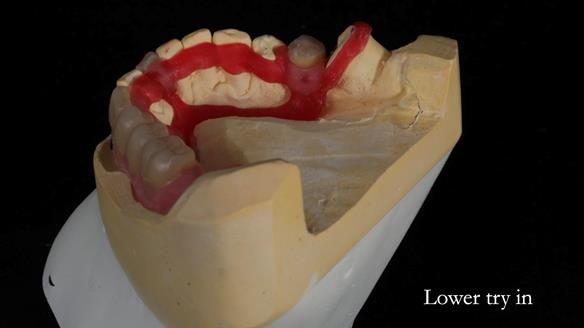 Newsletter 55 Provision of metal based partial dentures for Zephyrine with a repaired cleft lip and palate