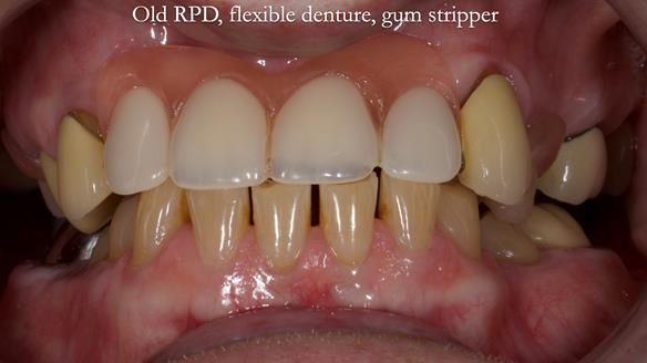 Newsletter 81 - Pam’s Story — how a partial denture changed her life (+ live walkthrough this Thursday)