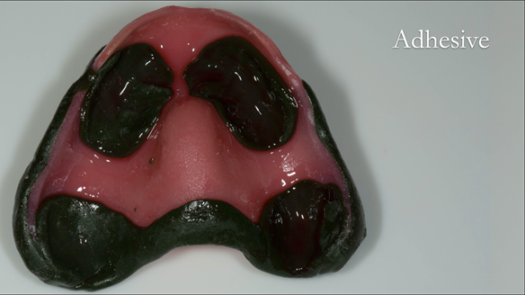 Figure 60 Upper custom tray prepared with alginate adhesive