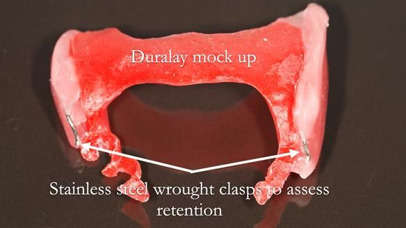 Solving Sue's failed implants with metal based RPD - full protocol Newsletter 43