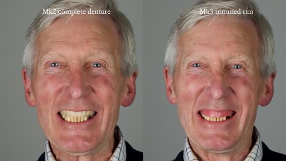 Newsletter 77: Jeremy’s case – immediate complete upper denture