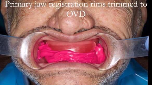 Managing poor implant positioning with complete dentures and Locator attachments - full protocol Newsletter 41