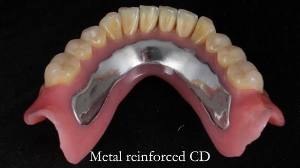 Finlay's Newsletter 62 provision of extractions and metal based complete dentures for Rafique