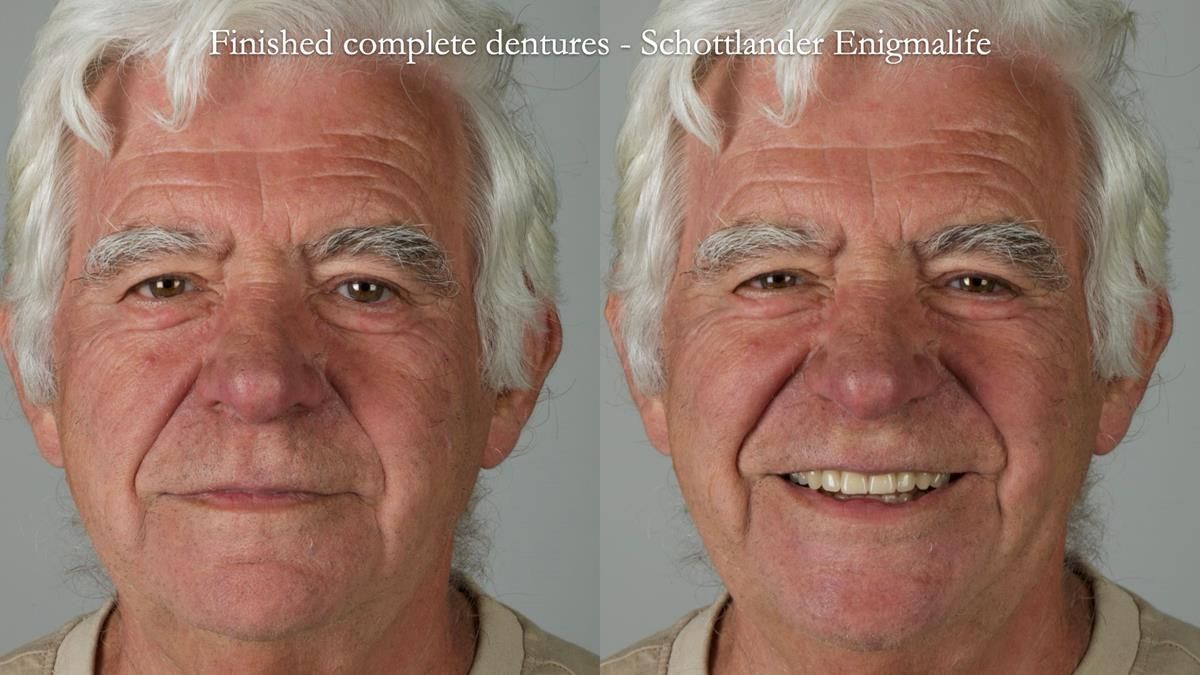Fin’s Newsletter 88 — Complete dentures - full protocol… he rearranged his own teeth!