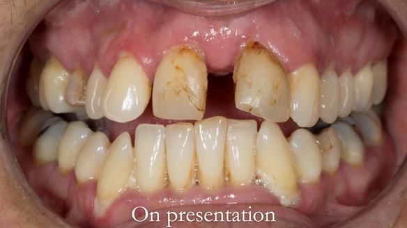 Finlay's Newsletter 63 Case study provision of metal based Scandinavian RPD - functional 10 years on