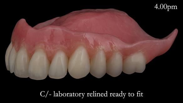 Newsletter 52 Managing Jo’s failing dentition with extractions and Mk 1/Mk 2 complete upper dentures and lower partial dentures FULL PROTOCOL