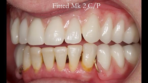 Newsletter 52 Managing Jo’s failing dentition with extractions and Mk 1/Mk 2 complete upper dentures and lower partial dentures FULL PROTOCOL