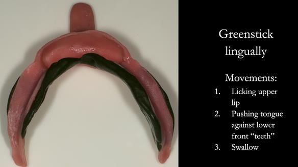 Greenstick right - right and left lingually from second molar to second molar – avoiding the retromolar pad - this is moulded in the patients mouth by the patient licking the upper lip from right to left commissures, pushing the tongue against the lower