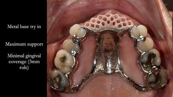 Finlay's Newsletter 63 Case study provision of metal based Scandinavian RPD - functional 10 years on