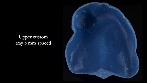 Newsletter 55 Provision of metal based partial dentures for Zephyrine with a repaired cleft lip and palate