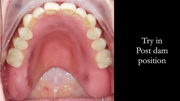 Newsletter 57 showcases the making and fitting process of implant-supported complete dentures for Alisdair