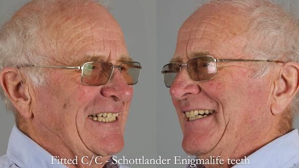 Complete denture Class II div 2 deep overbite Newsletter 39