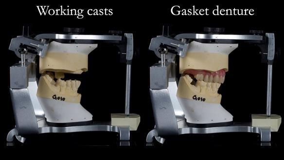 Finlay's Newsletter 58 Gasket upper partial denture for Zoe