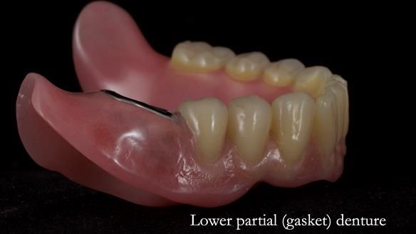 Newsletter 82 Mary - A complete upper and a one-tooth gasket denture
