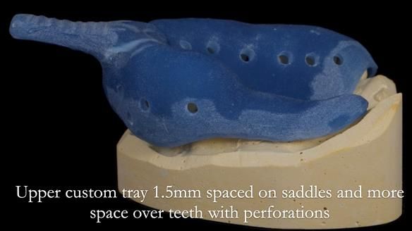 Finlay's Newsletter 64 case study - provision of a Kennedy class 2 metal based Scandinavian RPD for Ian