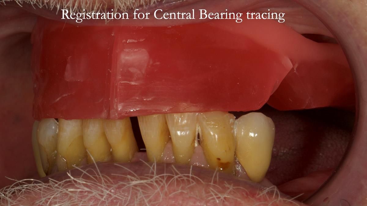 Newsletter 87 – Father Peter: A Partial Denture that needed Minor Miracle