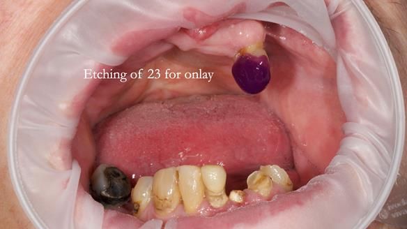 Newsletter 55 Provision of metal based partial dentures for Zephyrine with a repaired cleft lip and palate
