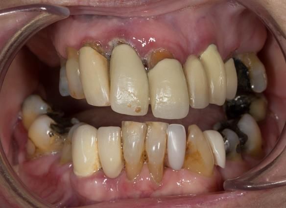 Figure 3 Pre - treatment. Failing upper teeth