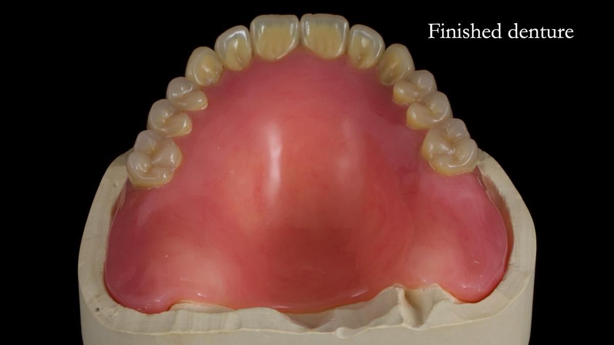 Fin’s Newsletter 88 — Complete dentures - full protocol… he rearranged his own teeth!