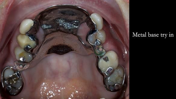 Newsletter 81 - Pam’s Story — how a partial denture changed her life (+ live walkthrough this Thursday)