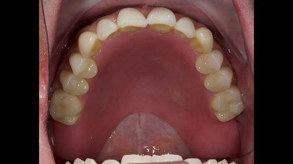 Newsletter 57 showcases the making and fitting process of implant-supported complete dentures for Alisdair