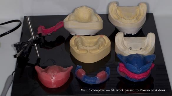 Newsletter 78: What do Clark Gable and a Locator® overdenture have in common?