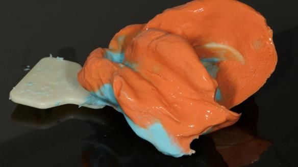 Complete denture Class II div 2 deep overbite Newsletter 39