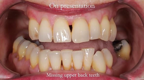 Newsletter 56 showing the making and fitting of a bilateral free end saddle upper removable partial denture (RPD) for patient with pemphigus