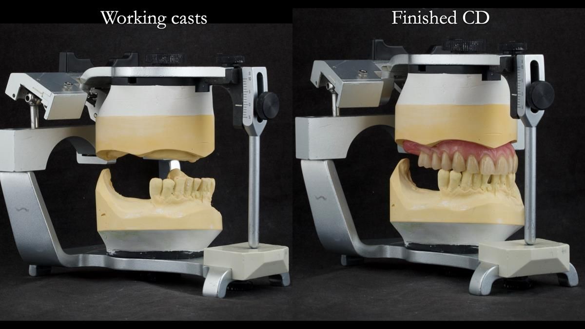 Newsletter 87 – Father Peter: A Partial Denture that needed Minor Miracle