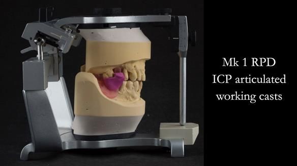 Finlay's Case Study Newsletter 40 - Immediate Mk 1 RPD to Definitive Mk 2 RPD - full protocol