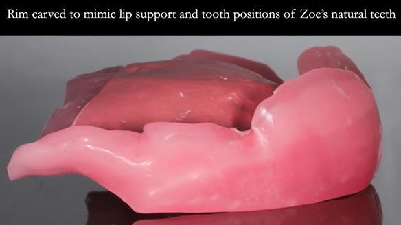 Finlay's Newsletter 58 Gasket upper partial denture for Zoe
