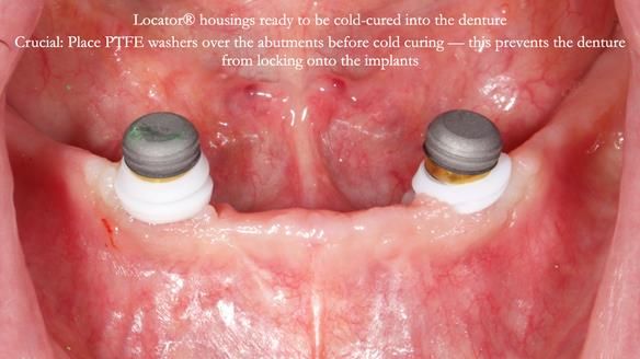 Newsletter 78: What do Clark Gable and a Locator® overdenture have in common?