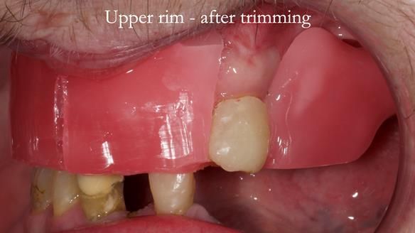Newsletter 55 Provision of metal based partial dentures for Zephyrine with a repaired cleft lip and palate