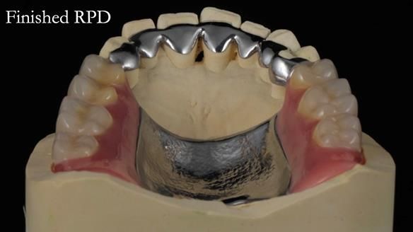 Newsletter 56 showing the making and fitting of a bilateral free end saddle upper removable partial denture (RPD) for patient with pemphigus